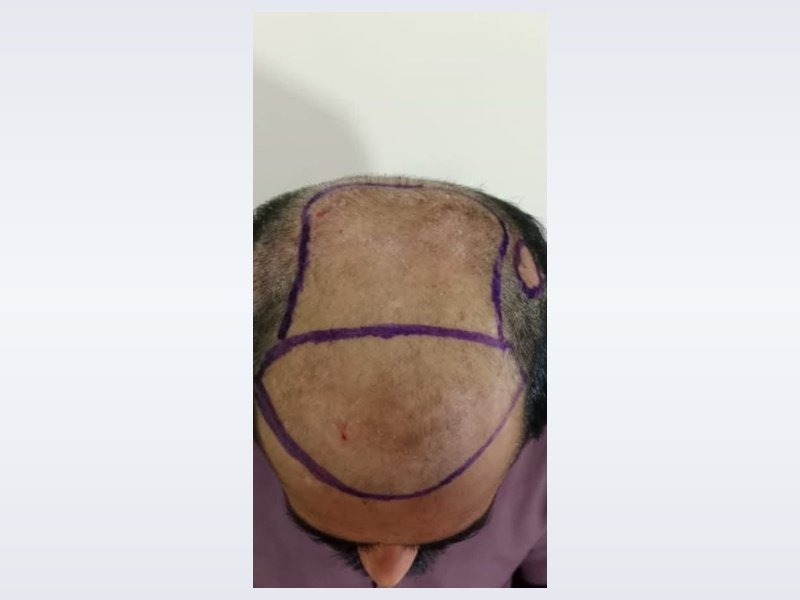 Patient Case 1: Baseline hair thinning before procedure
