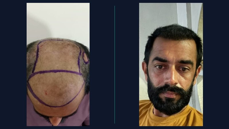 Patient Case 1: 4,650 FUE Grafts hairline restoration Before and After