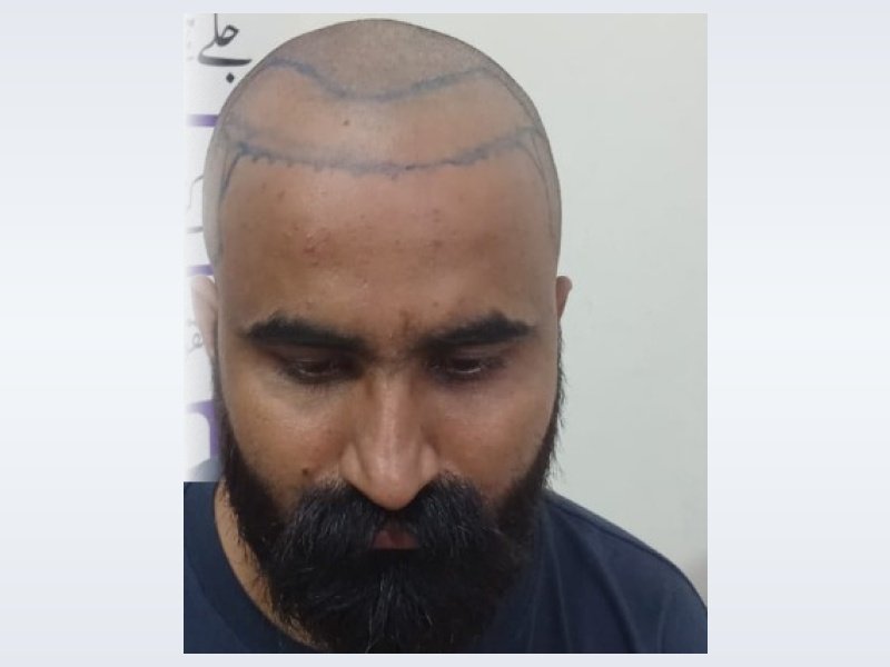 Patient Case 2: Baseline crown thinning before procedure