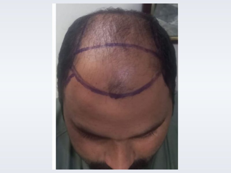 Patient Case 3: Advanced hair loss before treatment