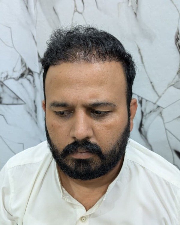 Patient Case 4: High density hair restoration mature result