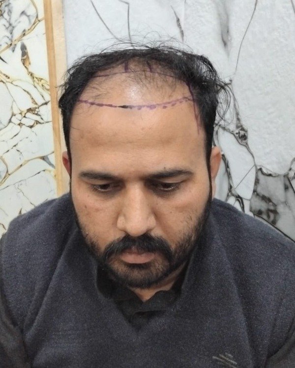 Patient Case 4: Advanced hairline recession before restoration