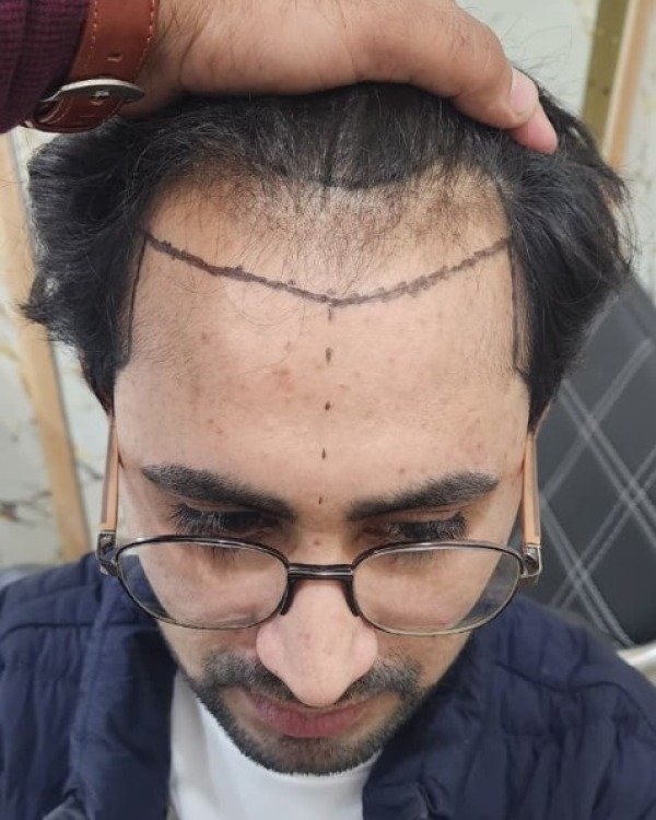 Patient Case 5: Temporal recession before procedure
