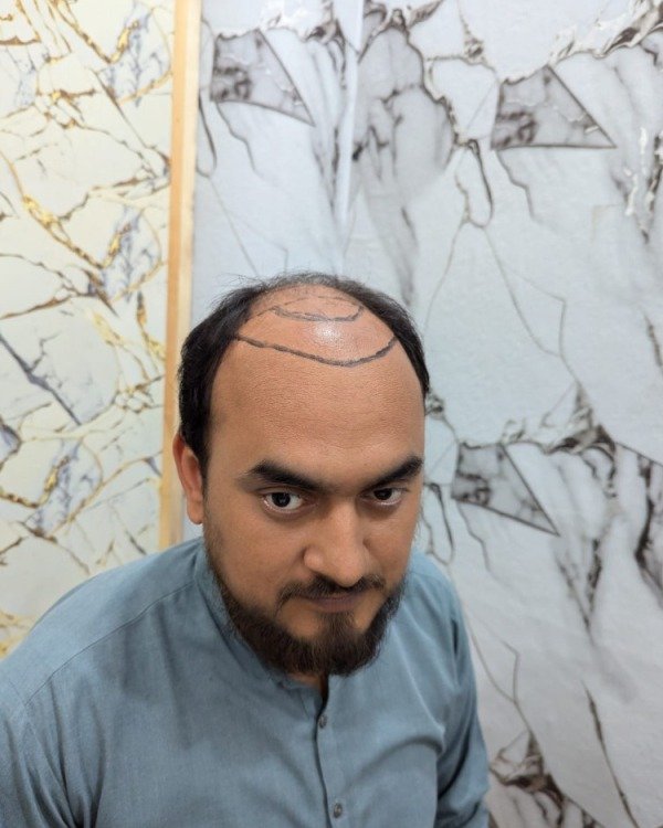 Patient Case 7: Frontal hairline thinning before restoration