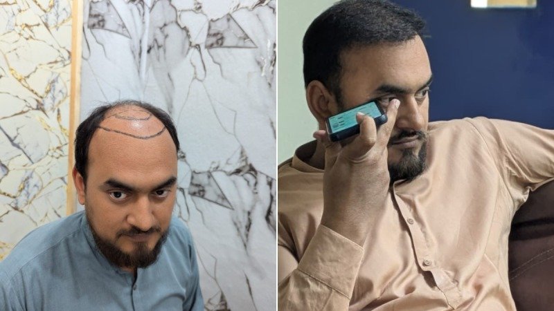 Patient Case 7: 4,700 Chinese Method Grafts hairline restoration Before and After