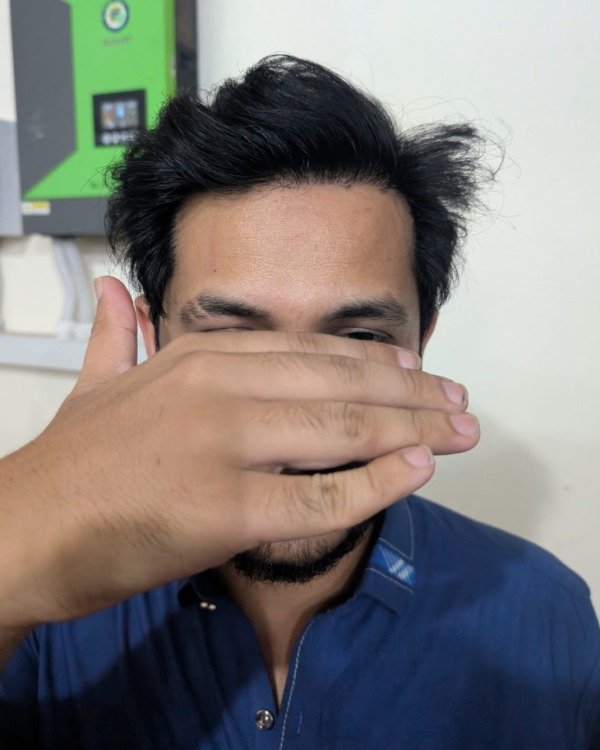 Patient Case 9: DHI frontal density after restoration
