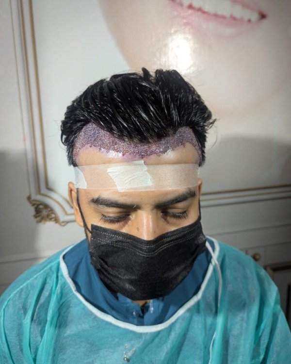 Patient Case 9: Frontal thinning before restoration