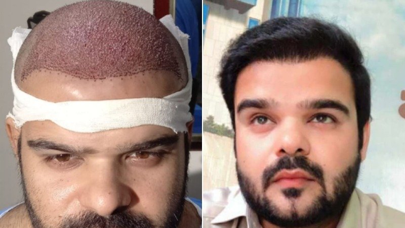 Patient Case 10: 4,900 FUE Mega-Session Complete Scalp Reconstruction Before and After