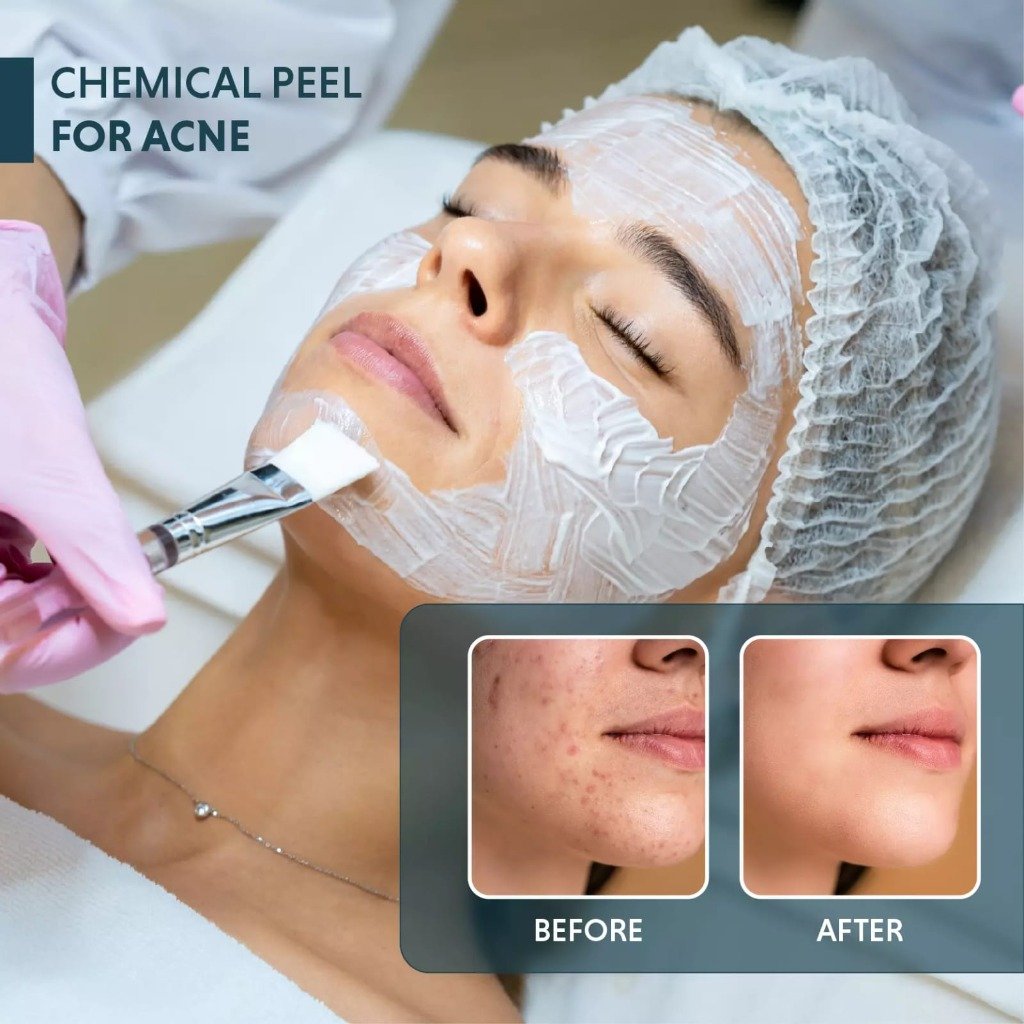Dermatological Chemical Peels in Faisalabad