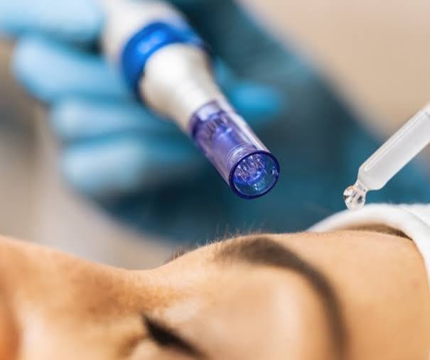 Medical Microneedling and Collagen Induction Therapy in Faisalabad