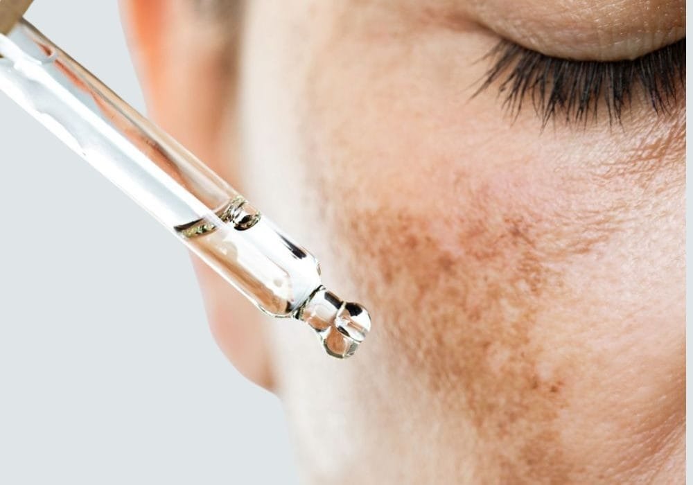 Pigmentation and Melasma Treatment