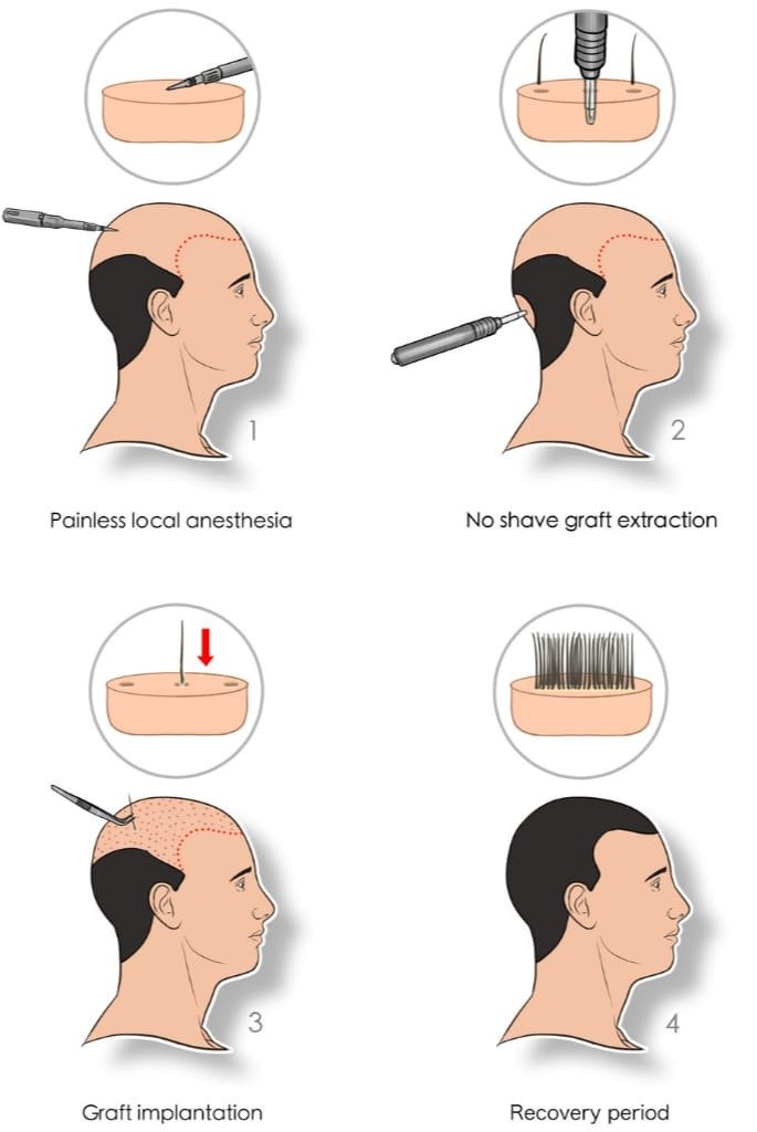 Chinese Method Hair Transplant Procedure Steps: 1. Painless local anesthesia, 2. No shave graft extraction, 3. Graft implantation, 4. Recovery period