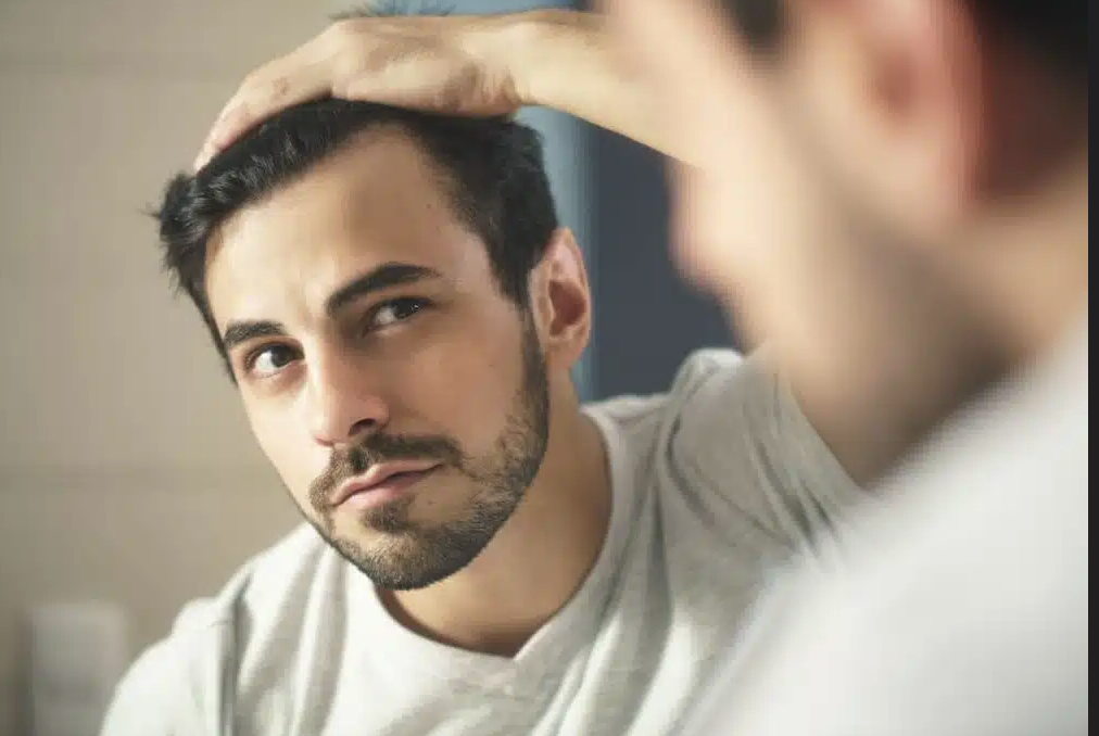 DHI Method Direct Hair Implantation Patient Result