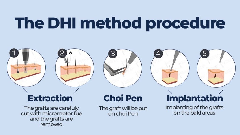 The DHI Method Procedure: Extraction, Choi Pen Loading, and Direct Implantation