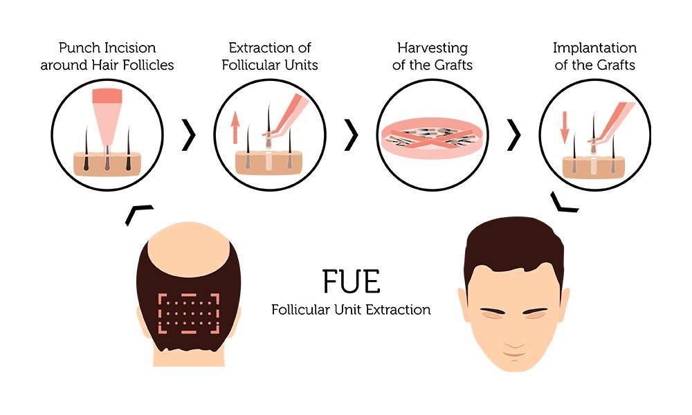 FUE Follicular Unit Extraction Procedure: Punch Incision, Extraction of Follicular Units, Harvesting of the Grafts, and Implantation