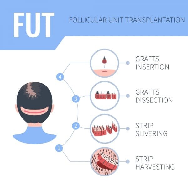 FUT Follicular Unit Transplantation Procedure: 1. Strip Harvesting, 2. Strip Slivering, 3. Grafts Dissection, 4. Grafts Insertion